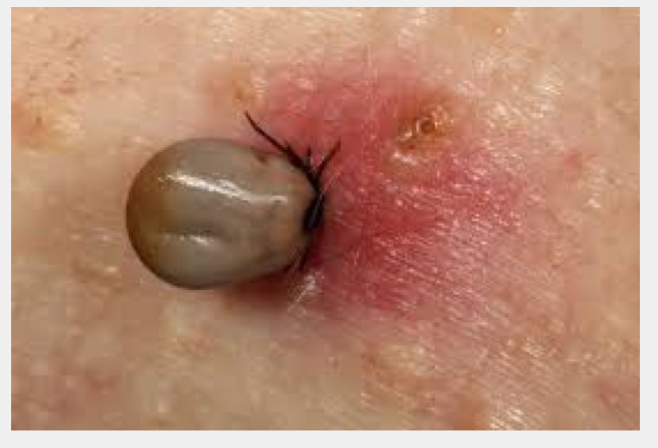 Tick Bite: Pictures, Symptoms, Treatments, Prevention See More