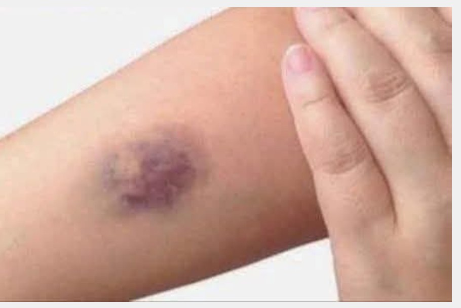 Understanding Bruises: Causes, Types, and Effective Treatments